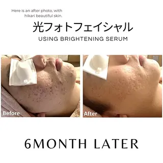 脱毛サロンHUGME 光フォトフェイシャルのエステ・リラクイメージ