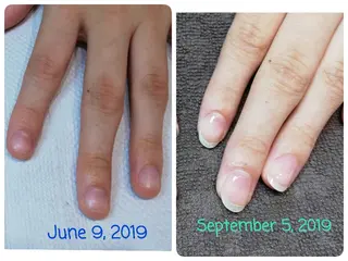 ネイル 深爪矯正/爪育成ケア manie nailのネイルデザイン