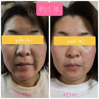 結果が出るスキンケア 肌質改善/まつパのエステ・リラクイメージ