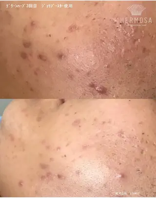 ニキビ•ニキビ跡改善 salon varyのエステ・リラクイメージ