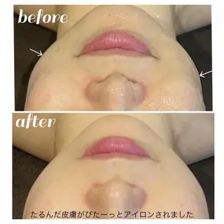 【ニキビ/肌管理】 salon varyのエステ・リラクイメージ