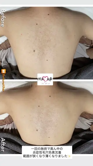 Meupニキビ専門店 背中/ハーブ/肌管理のその他イメージ