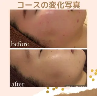 3か月で肌革命👼 ニキビ専門店💫のエステ・リラクイメージ