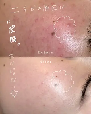 肌質改善✖️ 小顔｜Rikaのエステ・リラクイメージ