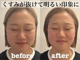 肌質改善×美容鍼 ゆいのエステ・リラクイメージ