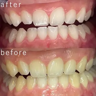 サクッとホワイト都立大学店所属・セルフホワイトニング 都立大学🦷✴︎のその他イメージ