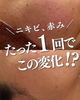 ニキビ特化型エステ 🍋最短で肌質改善のエステ・リラクイメージ