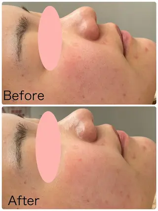 肌質改善ハーブピーリング専門Loy所属・Loy(ロイ)🍀 ハーブピーリング🌈のエステ・リラクイメージ