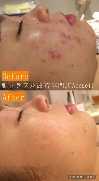 3か月で肌革命👼 ニキビ専門店💫のエステ・リラクイメージ