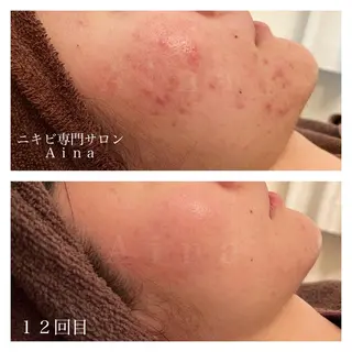 セミロング パーマ ヘアアレンジ メンズ キッズ ネイル マツエク・マツパ ニキビ跡専門サロン Ainaのエステ・リラクイメージ