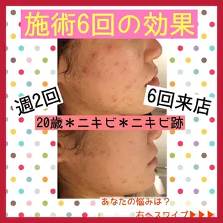 ミディアム パーマ ヘアアレンジ メンズ キッズ ネイル マツエク・マツパ ニキビ・肌質改善専門 ♡人生が変わるサロンのエステ・リラクイメージ