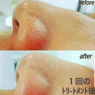 ニキビケア◇ニキビ跡 レゾン京橋店　八崎のエステ・リラクイメージ