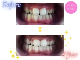 ホワイトニング rinaのその他イメージ