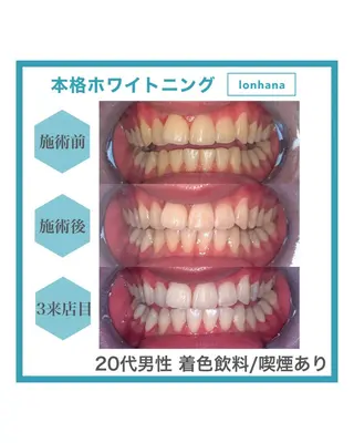 ホワイトニング｜韓国式3D毛穴洗浄 lonhana ﾛﾝﾊﾅ所属・韓国式3D毛穴洗浄 lonhanaのその他イメージ