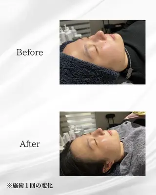 ハーブピーリング🌿 REVI/Ayanoのエステ・リラクイメージ