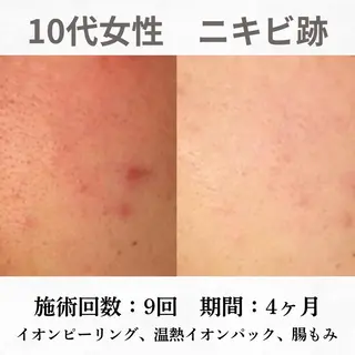 重度ニキビ専門🌷 ダウンタイムなしのエステ・リラクイメージ