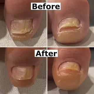 ネイル Mellow nail所属・巻爪無料モデル募集 ✨🦶MEGUMIのネイルデザイン