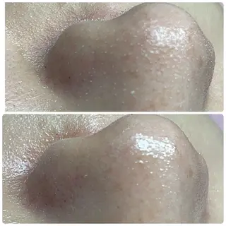 Chalon所属・REVI取扱・肌悩み 毛穴Chalonのエステ・リラクイメージ