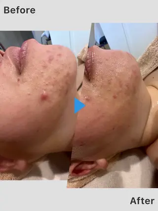 Auguspa〜オーガスパ〜所属・つるんとむき卵肌に 🌟ハーブピーリングのエステ・リラクイメージ