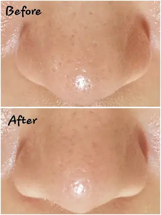 脱毛・ホワイトニング 耳ツボ・美白・毛穴のその他イメージ