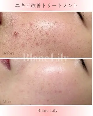 肌質改善サロンBlanc Lily【ブランリリー】所属・ピーリング専門サロン サロンブランリリーのエステ・リラクイメージ