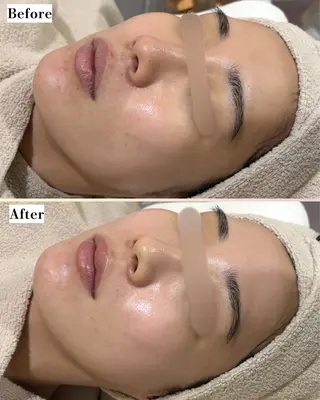 |ピーリング・毛穴| soina神楽坂のエステ・リラクイメージ