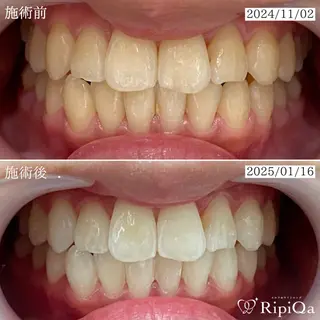 セルフホワイトニング RipiQaのその他イメージ