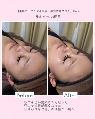 メンズ Mr.&Ms.脱毛/ ピーリング/RINAのエステ・リラクイメージ