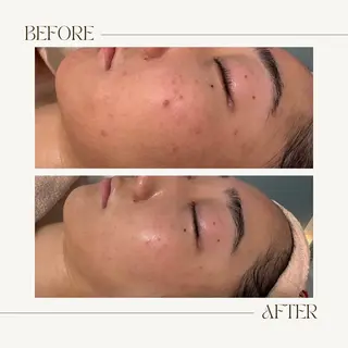 【ハーブピーリング】 Allumentのエステ・リラクイメージ