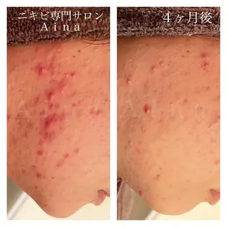 セミロング パーマ ヘアアレンジ メンズ キッズ ネイル マツエク・マツパ ニキビ跡専門サロン Ainaのエステ・リラクイメージ