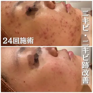ロング カラー パーマ ヘアアレンジ メンズ キッズ ネイル マツエク・マツパ アイブロウ 3か月で肌革命👼 ニキビ専門店💫のエステ・リラクイメージ