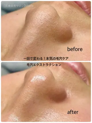 肌質改善Mbelle 越谷レイクタウン🌿のエステ・リラクイメージ