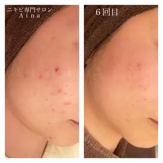 ミディアム カラー パーマ ヘアアレンジ メンズ キッズ ネイル マツエク・マツパ ニキビ跡専門サロン Ainaのエステ・リラクイメージ