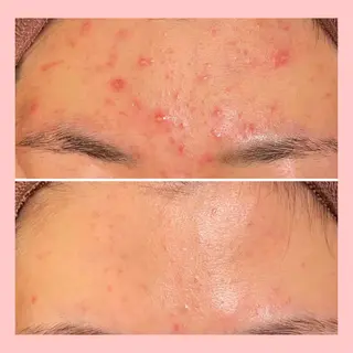 セミロング カラー パーマ ヘアアレンジ メンズ キッズ ネイル マツエク・マツパ アイブロウ 3か月で肌革命👼 ニキビ専門店💫のエステ・リラクイメージ