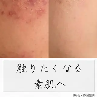 ニキビ経験者が施術 する専門サロン🌻のエステ・リラクイメージ