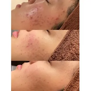 3か月で肌革命👼 ニキビ専門店💫のエステ・リラクイメージ