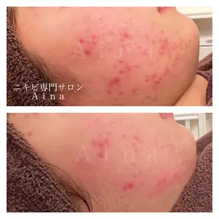 セミロング パーマ ヘアアレンジ メンズ キッズ ネイル マツエク・マツパ アイブロウ ニキビ跡専門サロン Ainaのエステ・リラクイメージ