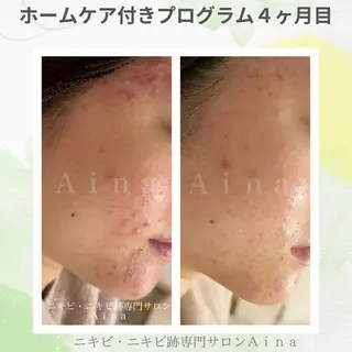 ニキビ跡専門サロン Ａｉｎａのエステ・リラクイメージ