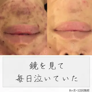 ニキビ経験者が施術 する専門サロン🌻のエステ・リラクイメージ