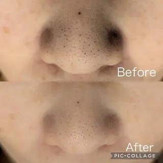 毛穴フェイシャルエステkokotto板橋所属・【毛穴ハーブピーリン グ】板橋1位のエステ・リラクイメージ