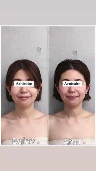 ハーブピーリング 肌再生ピーリング/のエステ・リラクイメージ