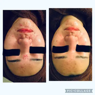 ニキビ/肌質改善専門 Snow skinのエステ・リラクイメージ