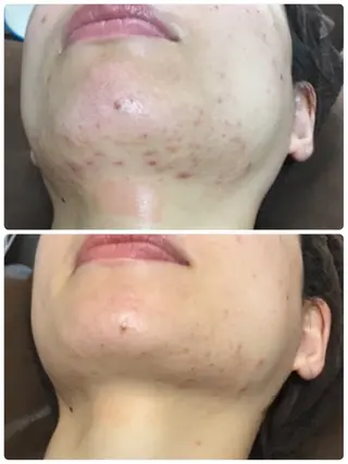 3/25迄ハーブ ピーリングBloomのエステ・リラクイメージ