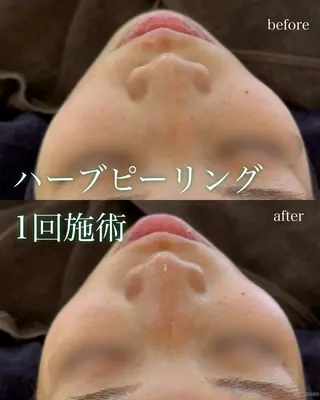 yukiko/美容師 ニキビ特化/肌質改善のエステ・リラクイメージ