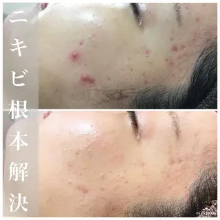 ニキビ・毛穴改善 🌿ハーブピーリングのエステ・リラクイメージ