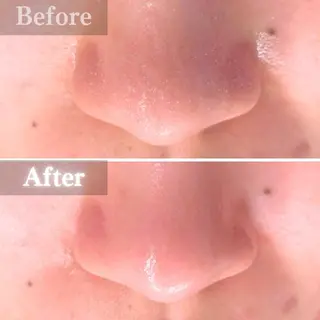 毛穴洗浄特化🫧 オオツカのエステ・リラクイメージ