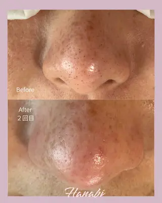 毛穴専門サロン Hanabiのエステ・リラクイメージ