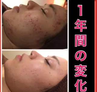 ミディアム パーマ ヘアアレンジ メンズ キッズ ネイル マツエク・マツパ ニキビ・肌質改善専門 ♡人生が変わるサロンのエステ・リラクイメージ