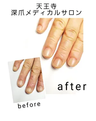 ネイル 天王寺 深爪メディカルサロンのネイルデザイン