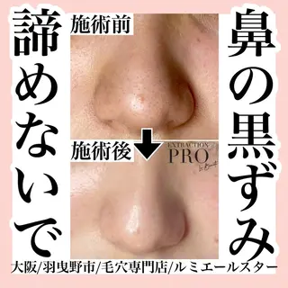 最速 毛穴シミ改善 いくえのその他イメージ